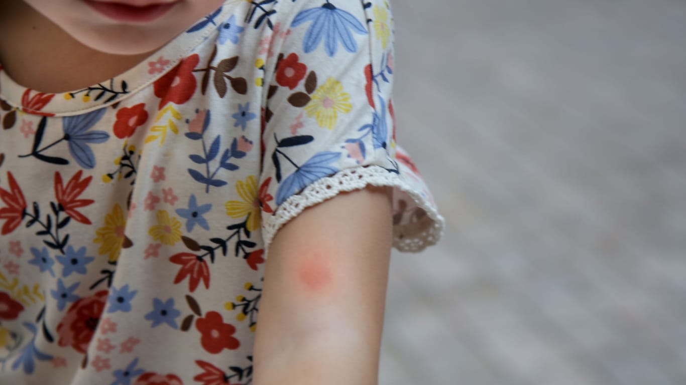 Kind mit Mückenstich