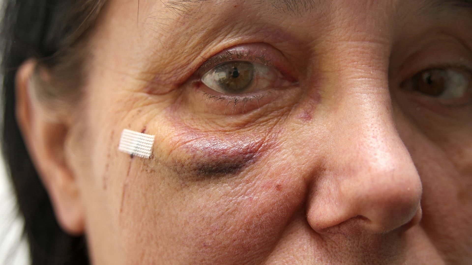 Frau mit blauem Auge (Symbolbild): 34 Prozent der jungen Männer in Deutschland sind nach eigenen Angaben Frauen gegenüber bereits handgreiflich geworden.