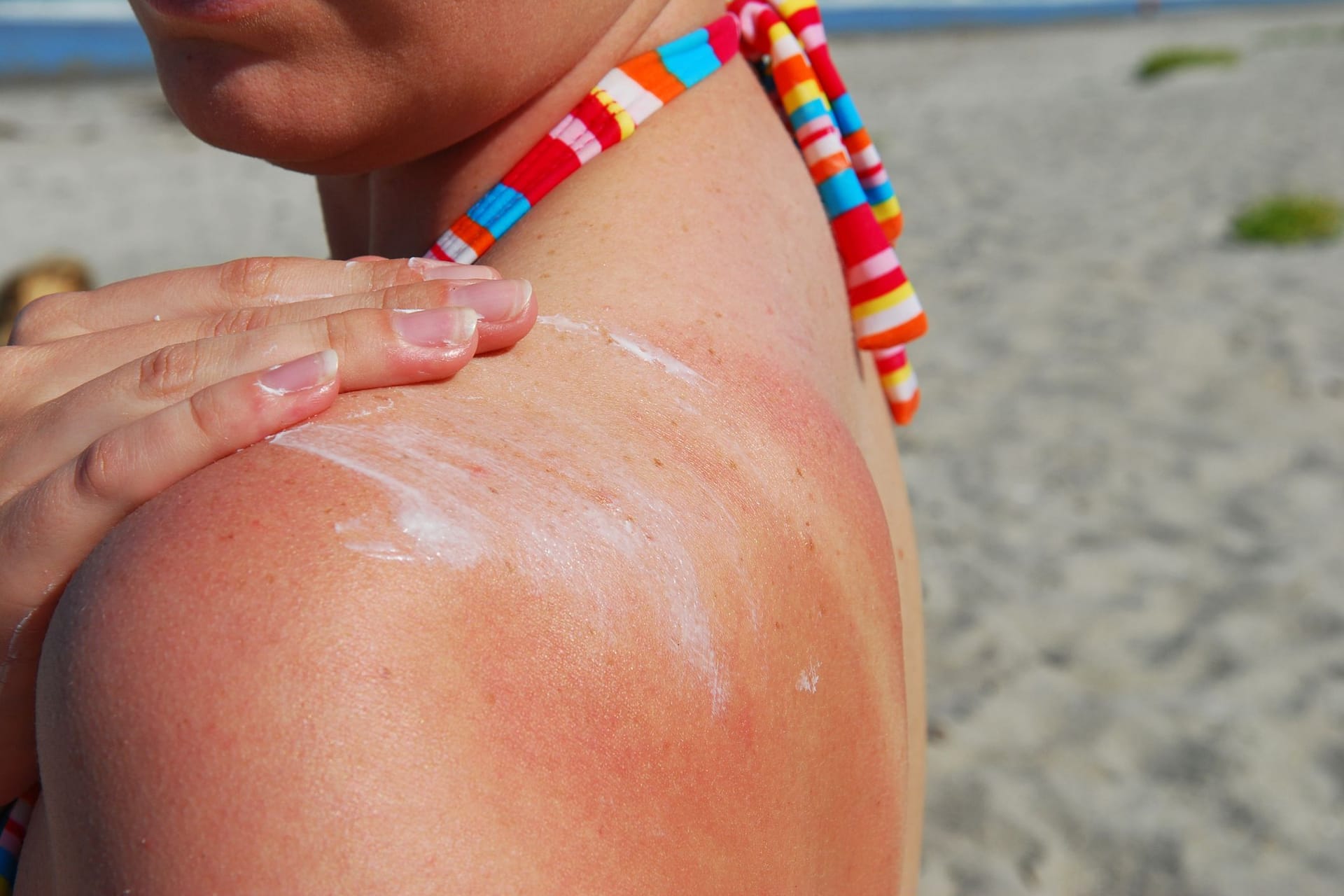 Sonnenbrand (Symbolbild): Viele Menschen leiden unter den hohen Temperaturen.