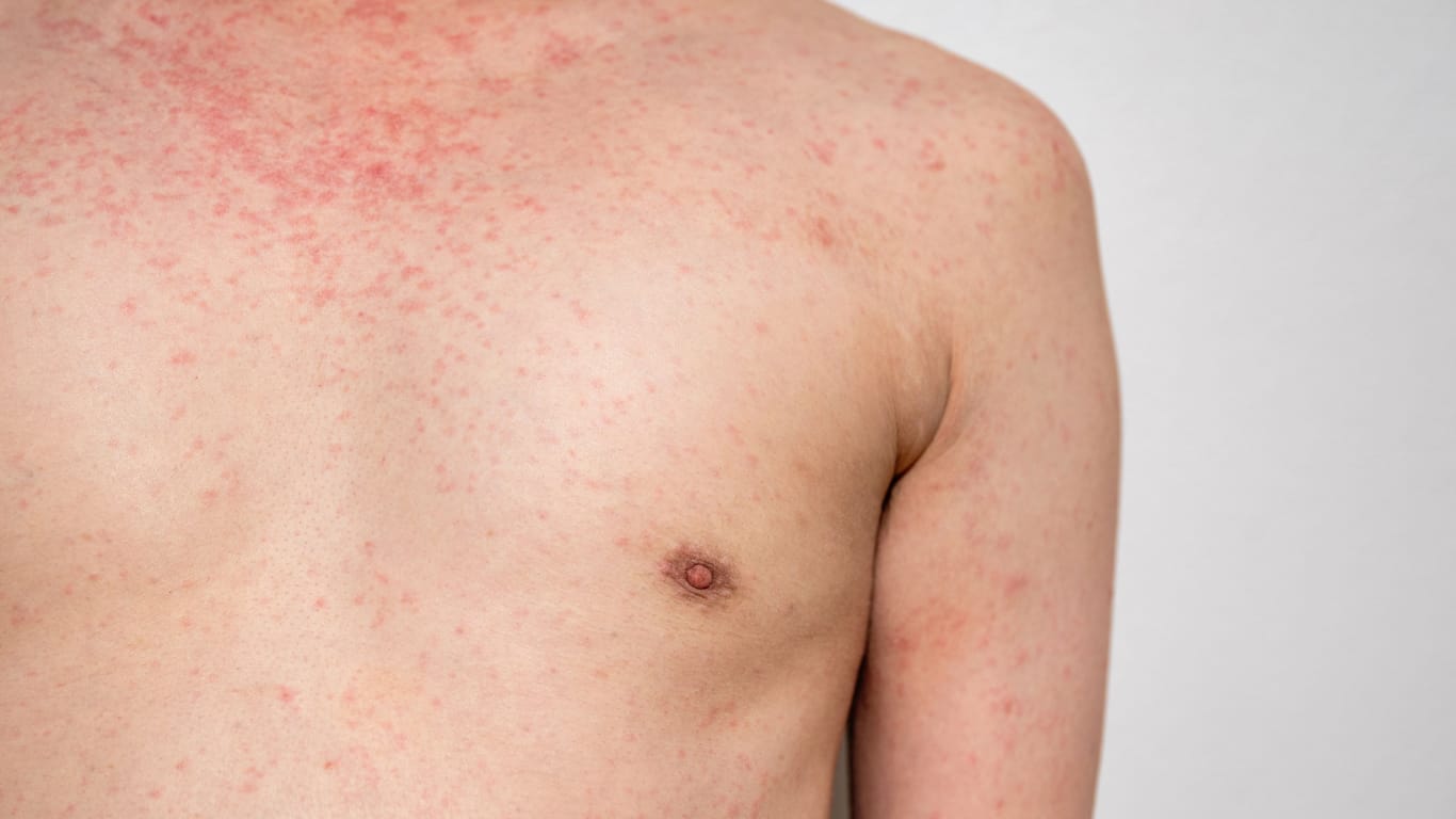 Ausschalg am ganzen Körper: Feine rote Pusteln können bei Hepatitis A auftreten.