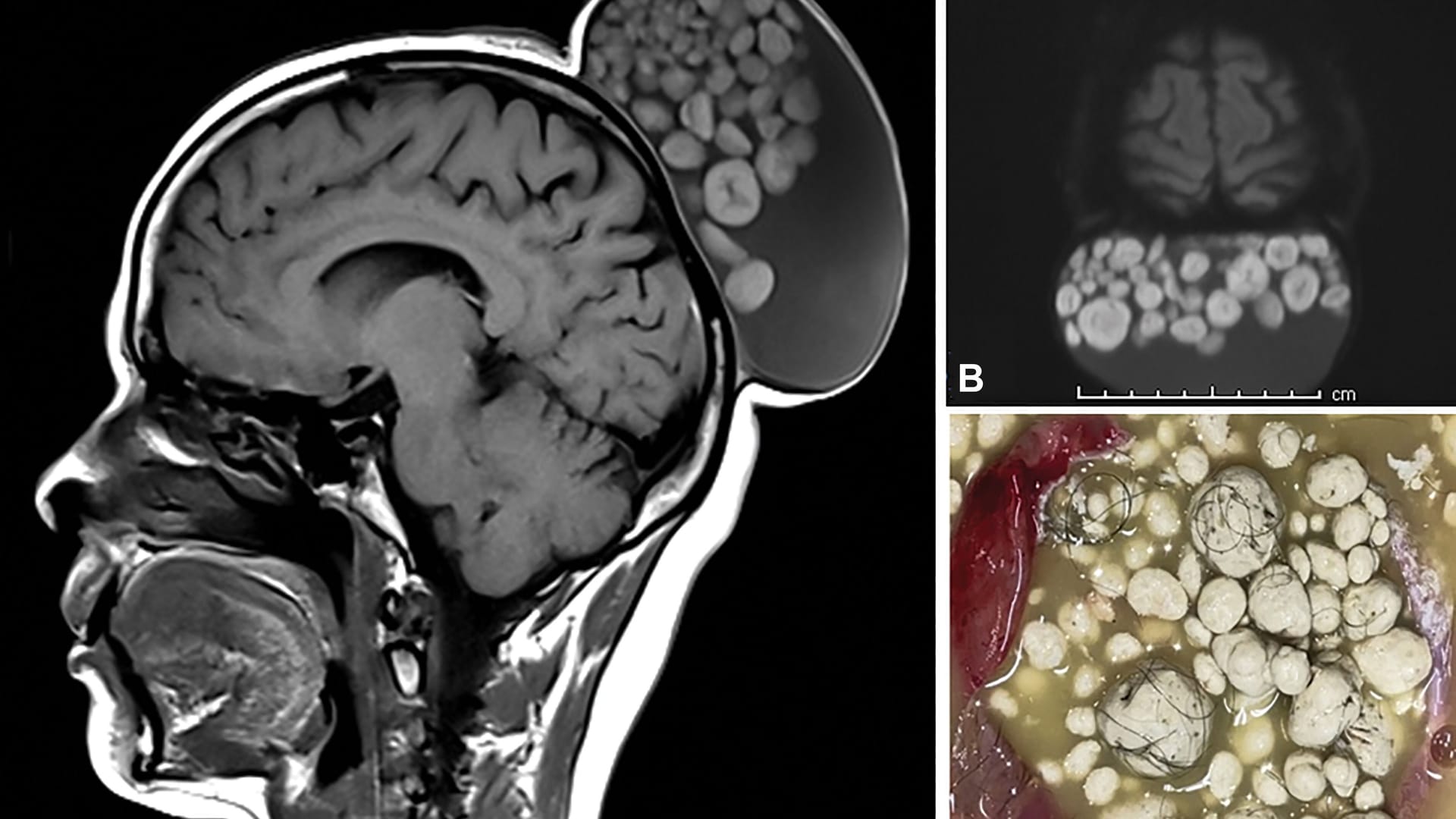 MRT-Bild des Tumors am Hinterkopf der 52-Jährigen: Sie gab an, den Tumor seit ihrer Kindheit zu haben.