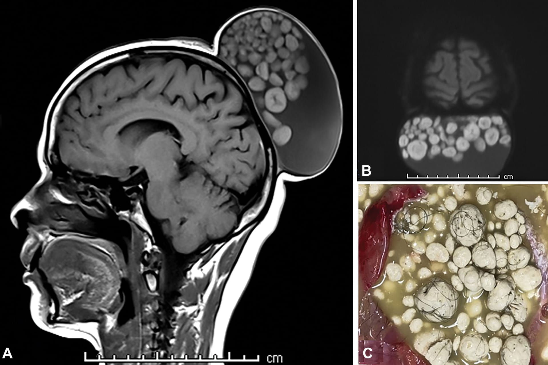 MRT-Bild des Tumors am Hinterkopf der 52-Jährigen: Sie gab an, den Tumor seit ihrer Kindheit zu haben.