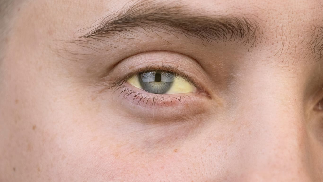 Eine Gelbfärbung der Augen ist ein typischer Hinweis auf eine Hepatitis.