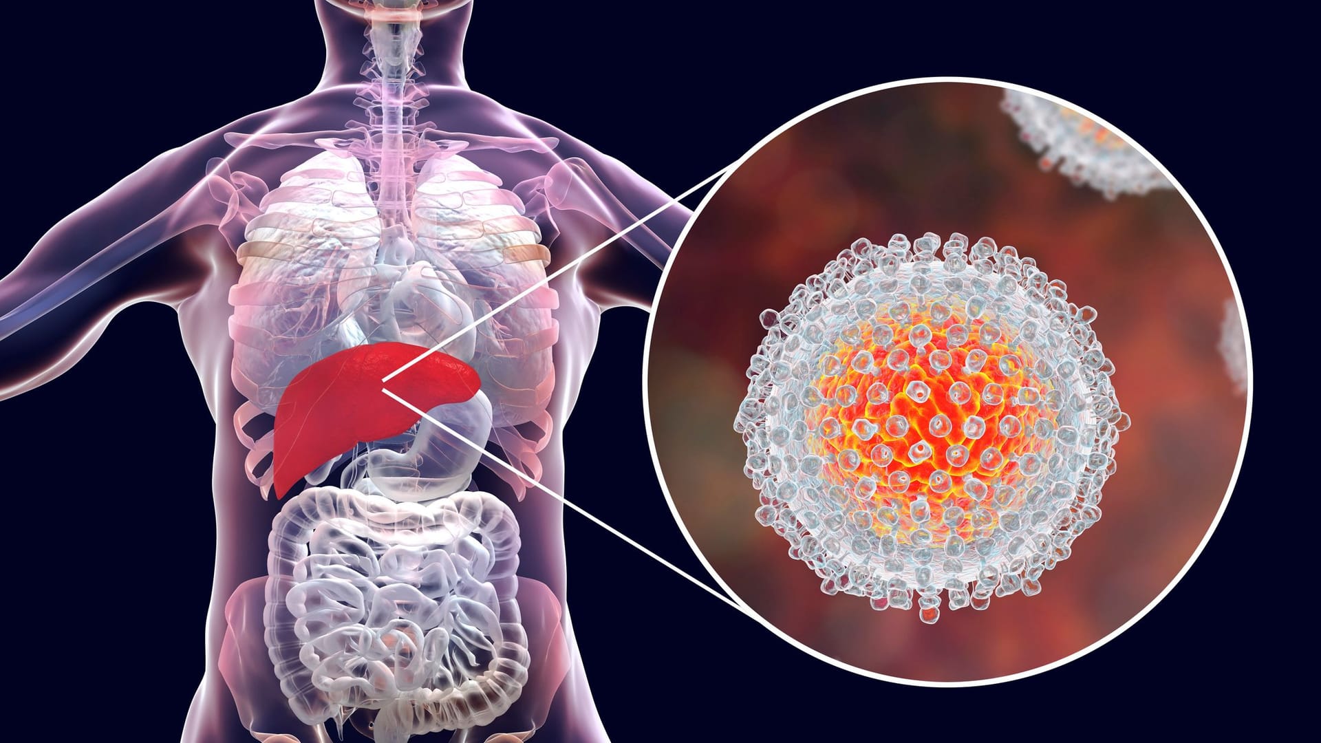 Leberentzündung (Hepatitis): Eine Entzündung der Leber wird als Hepatitis bezeichnet, wobei unter einer akuten und chronischen unterschieden wird. Hepatitis hat viele Ursachen, neben einer Infektion mit Hepatitis A, B, C, D oder E Viren können das auch eine Fettleber, Bakterien, Autoimmunerkrankungen oder ein hoher Alkoholkonsum sein. Bei schweren Fällen treten Symptome wie Gelbsucht oder starke Schmerzen im Oberbauch auf und könnten unbehandelt zu Leberversagen führen.