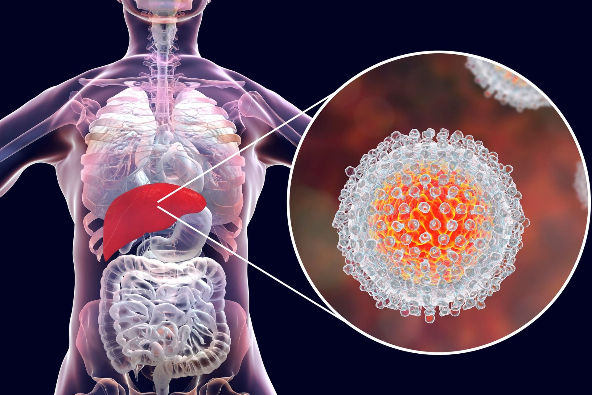 Leberentzündung (Hepatitis): Eine Entzündung der Leber wird als Hepatitis bezeichnet, wobei unter einer akuten und chronischen unterschieden wird. Hepatitis hat viele Ursachen, neben einer Infektion mit Hepatitis A, B, C, D oder E Viren können das auch eine Fettleber, Bakterien, Autoimmunerkrankungen oder ein hoher Alkoholkonsum sein. Bei schweren Fällen treten Symptome wie Gelbsucht oder starke Schmerzen im Oberbauch auf und könnten unbehandelt zu Leberversagen führen.