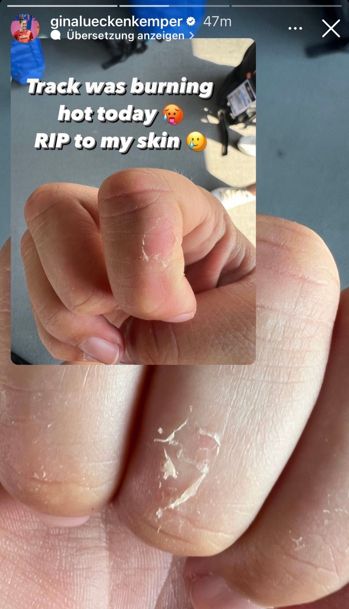 Lückenkemper auf Instagram: Sie zeigt ihre geschälten Finger.