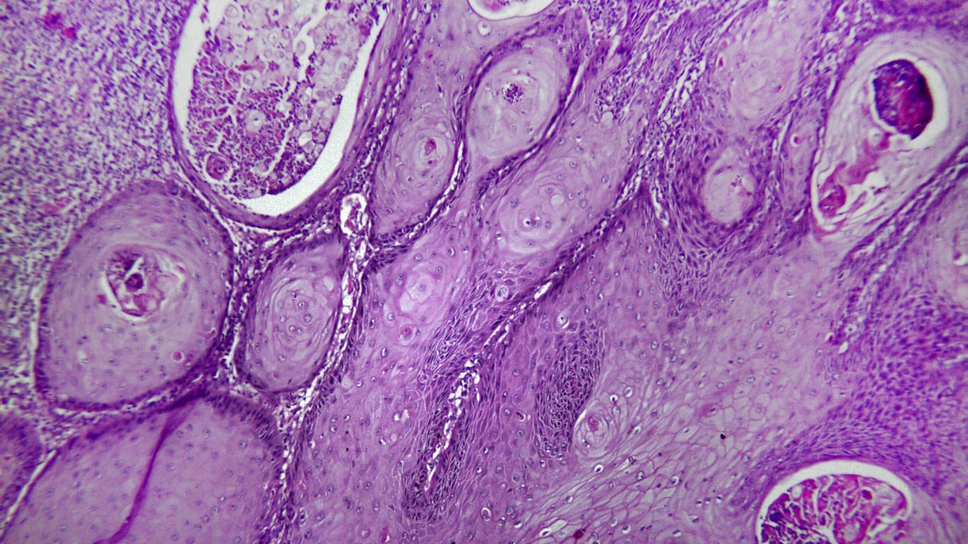 Gewebe eines Hautkarzinoms unter dem Mikroskop.