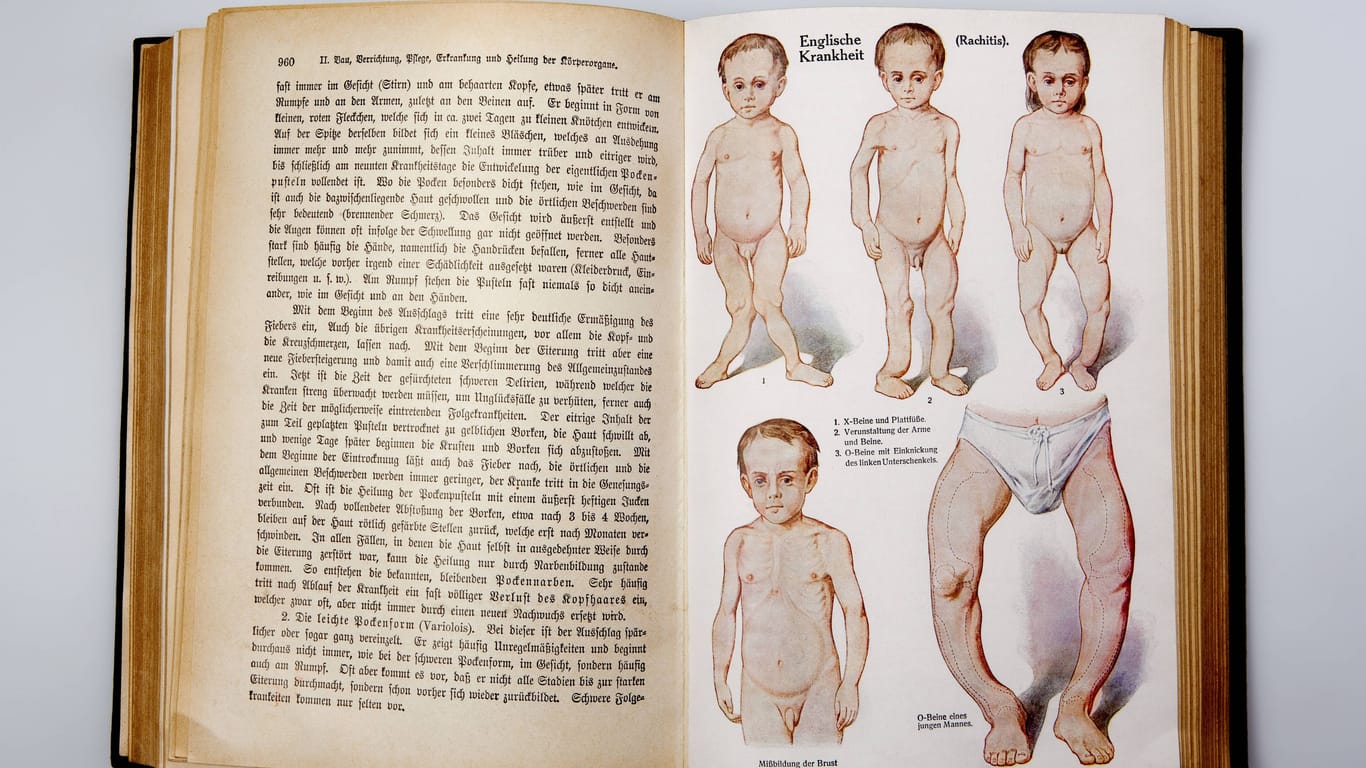 Illustrationen aus dem Buch "Dr. F. König's Ratgeber in gesunden und kranken Tagen" (1928): An Rachitis Erkrankte weisen oft Verkrümmungen im Skelett auf.