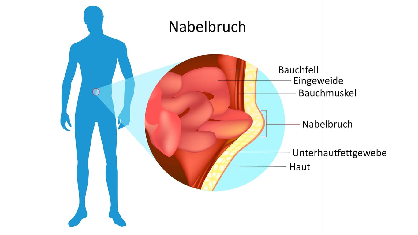 Illustration eines Nabelbruchs