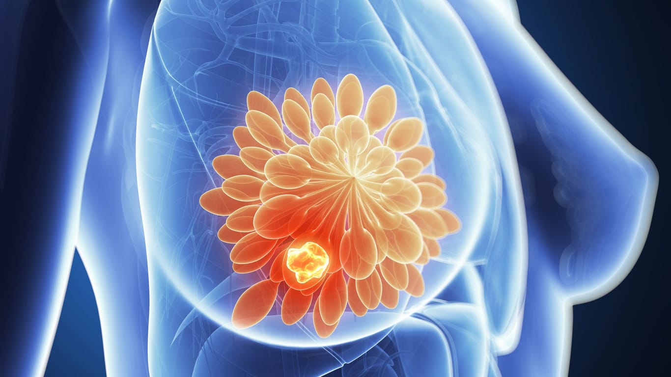 Östrogene spielen bei der Entstehung von Brustkrebs eine wichtige Rolle.