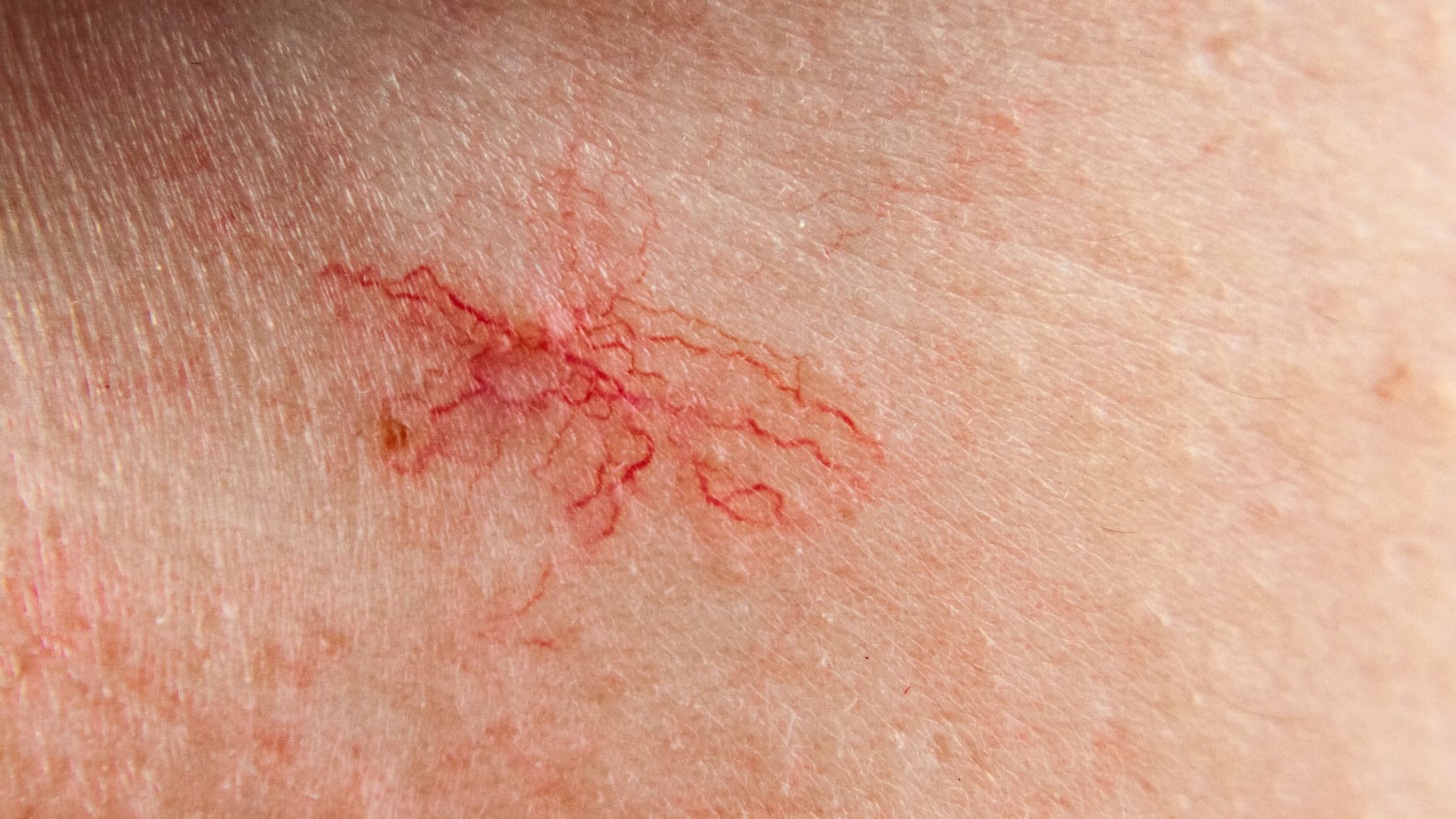 Leber Lebersternchen Symptom für Leberschäden auf der Haut Leber Lebersternchen Symptom für Leberschäden auf der Haut