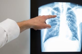 Corona-Maßnahmen belasten Kampf gegen Tuberkulose