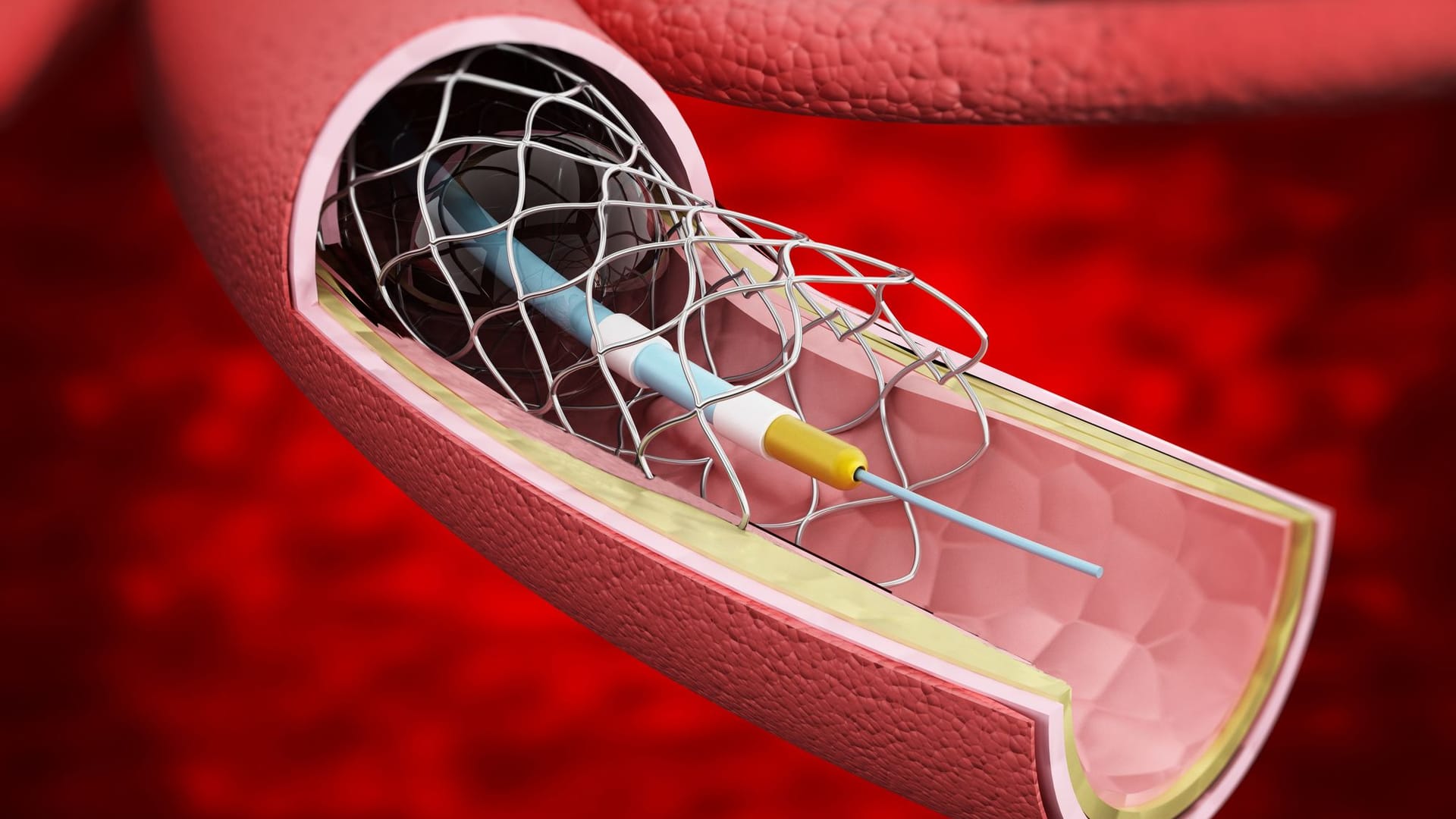 Herzkatheteruntersuchung: Ein Stent dient als Gefäßstütze für ein verengtes Herzkranzgefäß.