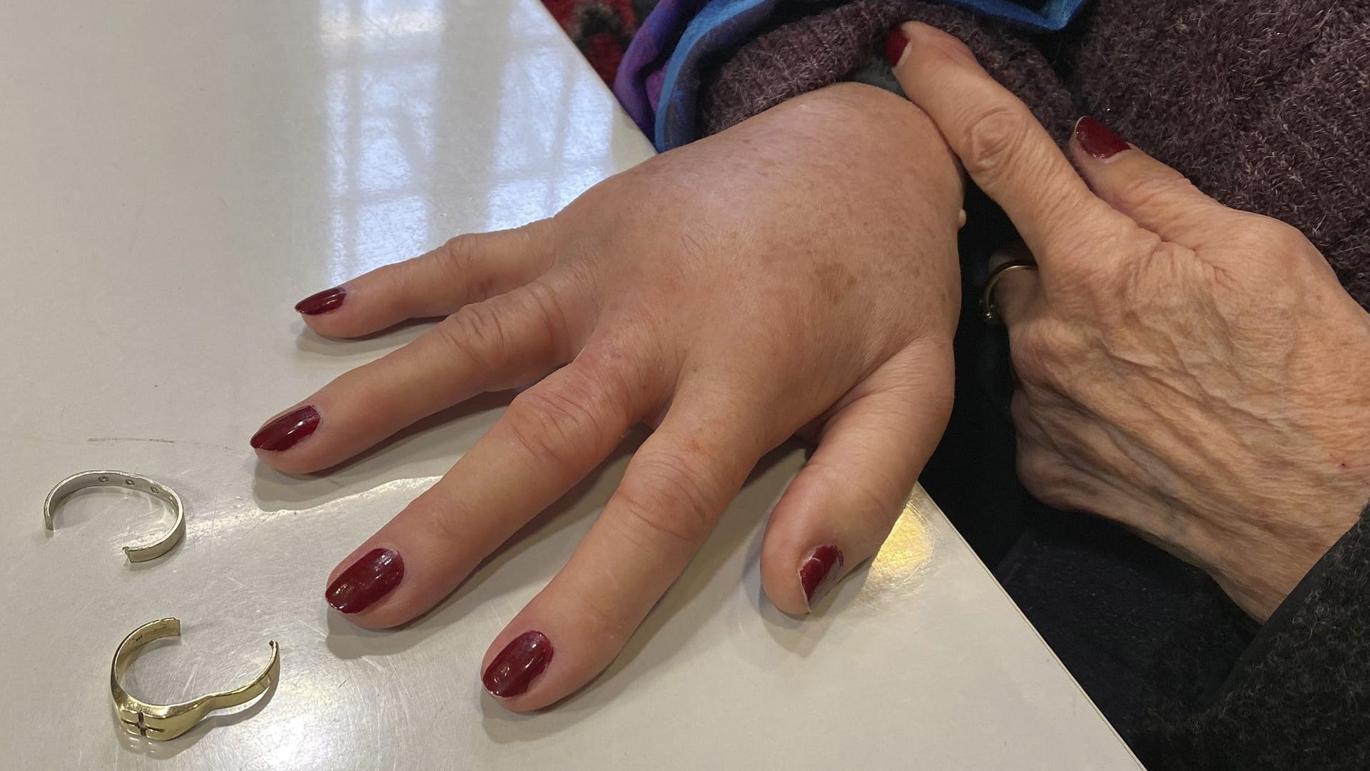 Sichtlich angeschwollene Hand: Mit Spezialwerkzeug befreite die Feuerwehr die Frau von den Ringen. Sichtlich angeschwollene Hand: Mit Spezialwerkzeug befreite die Feuerwehr die Frau von den Ringen.