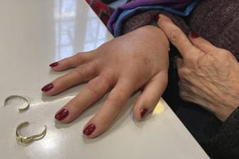 Sichtlich angeschwollene Hand: Mit Spezialwerkzeug befreite die Feuerwehr die Frau von den Ringen.