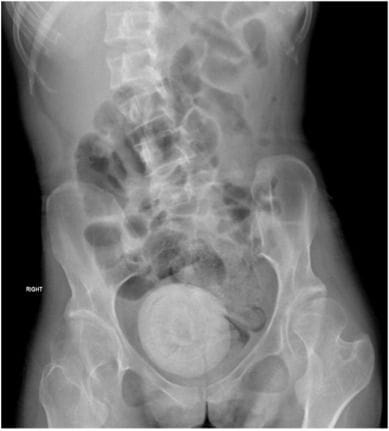 Röntgenaufnahme eines Vaginalstein: Häufig wird dieses seltene Phänomen mit Niere- oder Blasensteinen verwechselt.