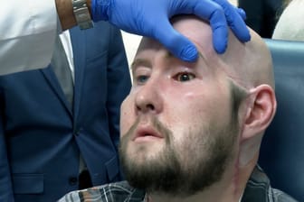 US-Chirurgen transplantieren vollständiges Auge