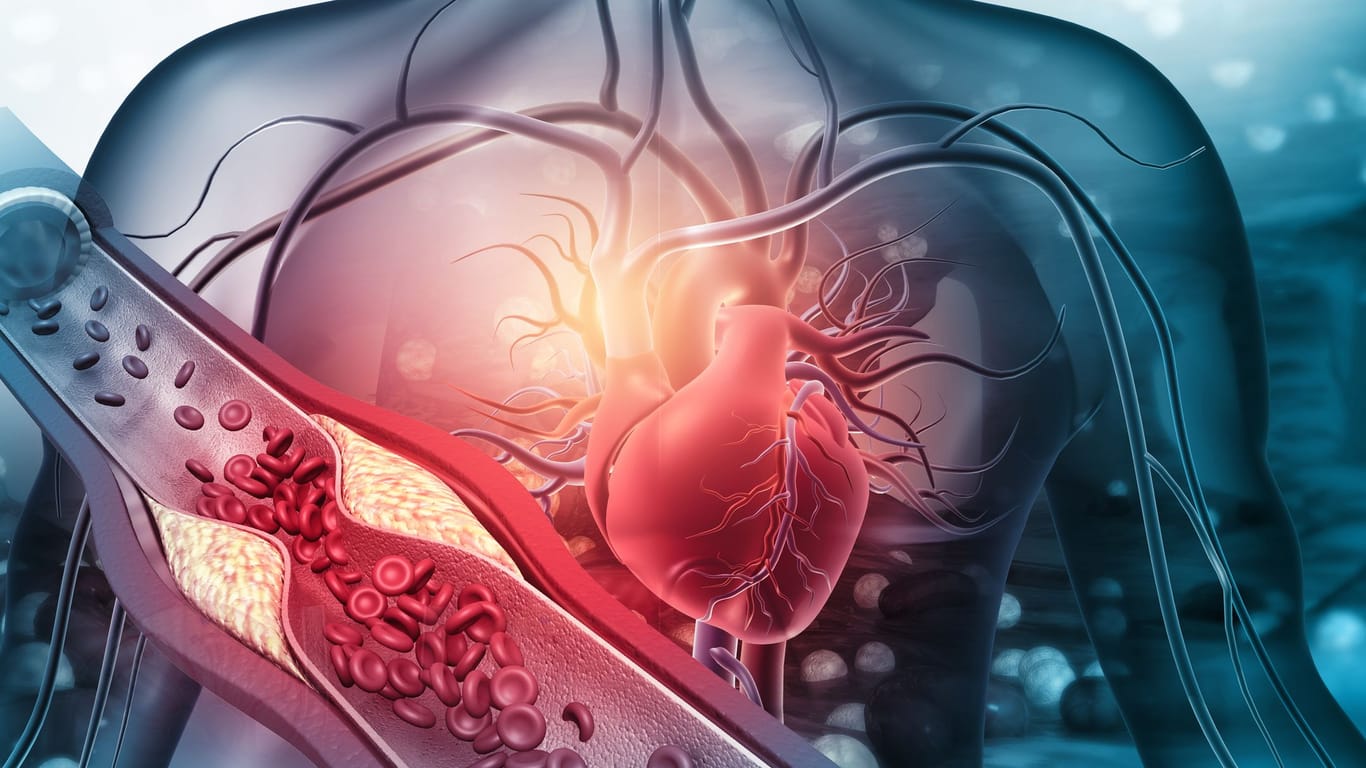 Bei der koronaren Herzkrankheit führen Gefäßablagerungen zu einer Verengung der Herzkranzgefäße, der sogenannten Koronararterien.