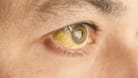 Person mit Gelbsucht der Augen.