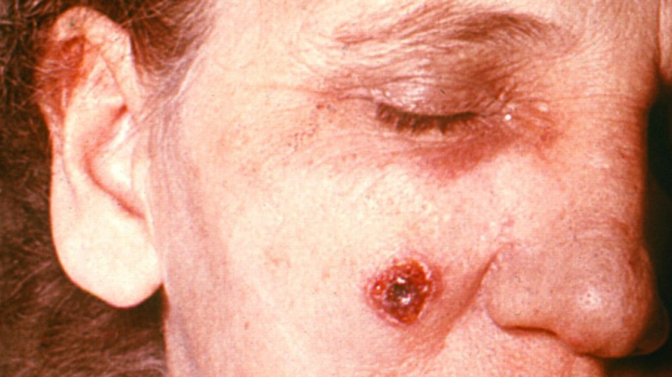 Hautmilzbrand im Gesicht einer Frau: Die Infektionsstelle wird Papel genannt, sie ist schmerzlos, aber gefährlich.