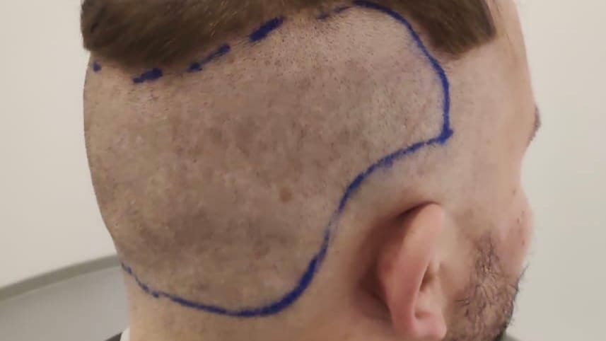 Kurz vor der Haartransplantation: Der Spenderbereich im Nacken muss rasiert werden.