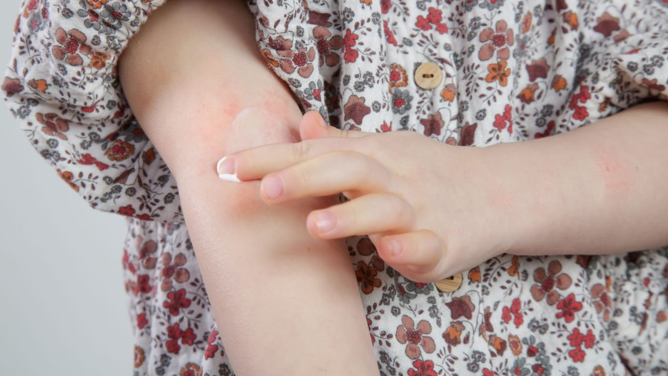 Juckende Rötungen an den Innenseiten der Arme deuten können hinweise auf eine Neurodermitis sein. Im Gegensatz zu Babys sind die Stellen bei älteren Kindern meist nicht nass.