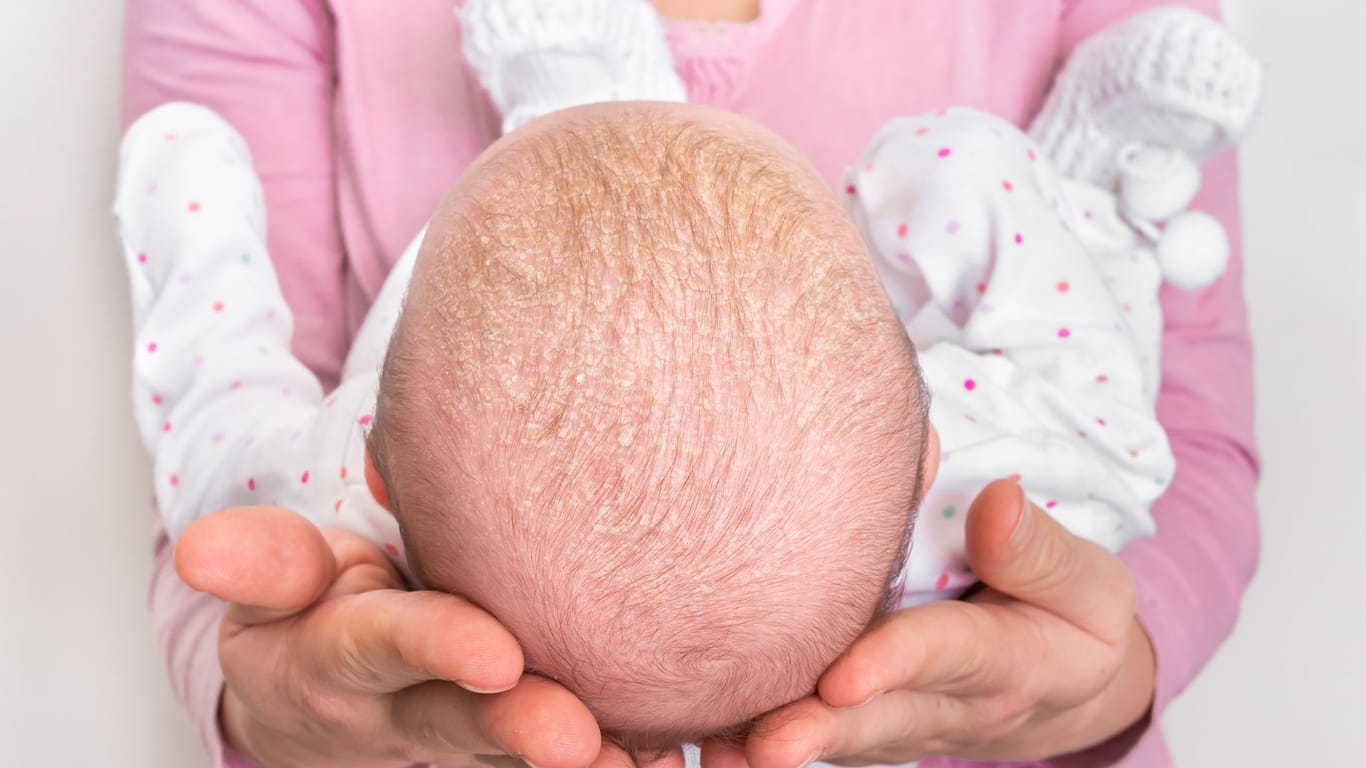 Milchschorf auf dem Kopf von Säuglingen ist harmlos und verschwindet meist schnell wieder. Manchmal aber kann er auch ein Hinweis auf eine beginnende Neurodermitis sein.