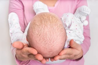 Milchschorf auf dem Kopf von Säuglingen ist harmlos und verschwindet meist schnell wieder. Manchmal aber kann er auch ein Hinweis auf eine beginnende Neurodermitis sein.