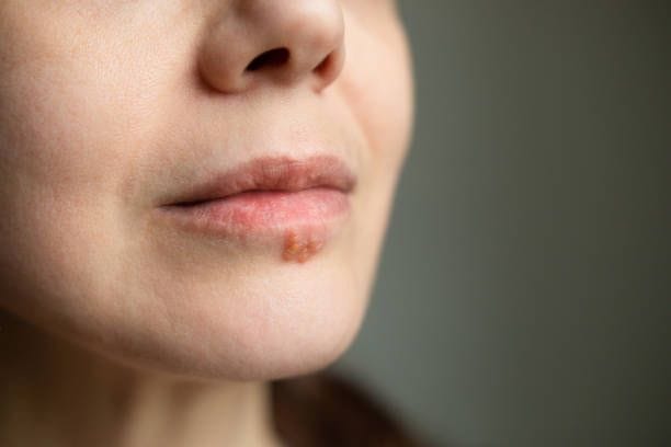 Herpes: Die Erkrankung wird durch Viren ausgelöst und ist hochansteckend.