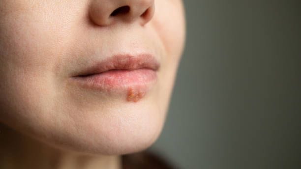 Herpes: Die Erkrankung wird durch Viren ausgelöst und ist hochansteckend.