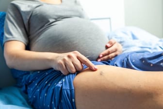 Schwangere Frau deutet auf eine Krampfader am Oberschenkel: In der Schwangerschaft verändert sich der Körper auf eine Weise, die Krampfadern begünstigt.