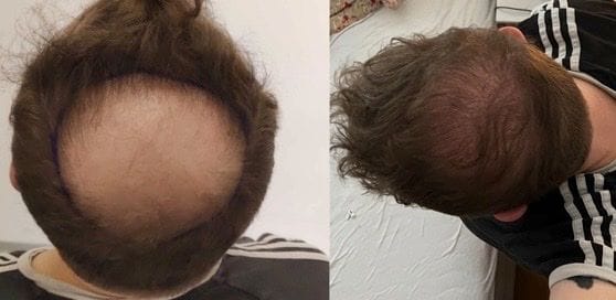 Ergebnis der Haartransplantation (rechts) bei schwächerem Licht.