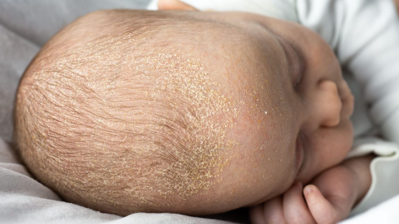 In folge einer Neurodermitis bildet sich bei Säuglingen oft Milchschorf auf dem Kopf.