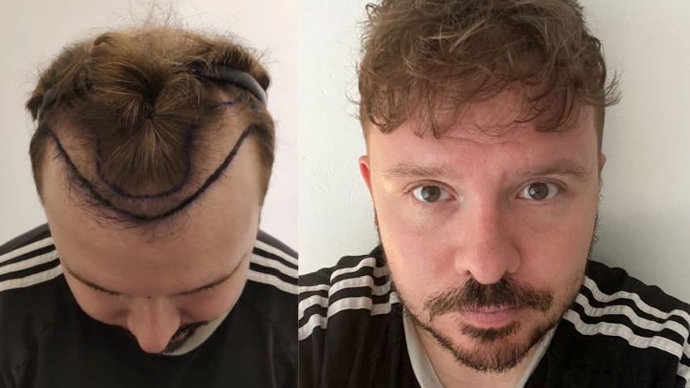 Ergebnis der Haartransplantation (rechts) vorne: Durchweg ein gutes Ergebnis.