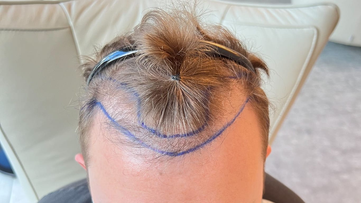 Die neue Haarlinie: In diesem Streifen sollten vorne Haare transplantiert werden.