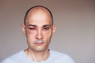 Ein Mann mit einem Angioödem im Bereich der Augen
