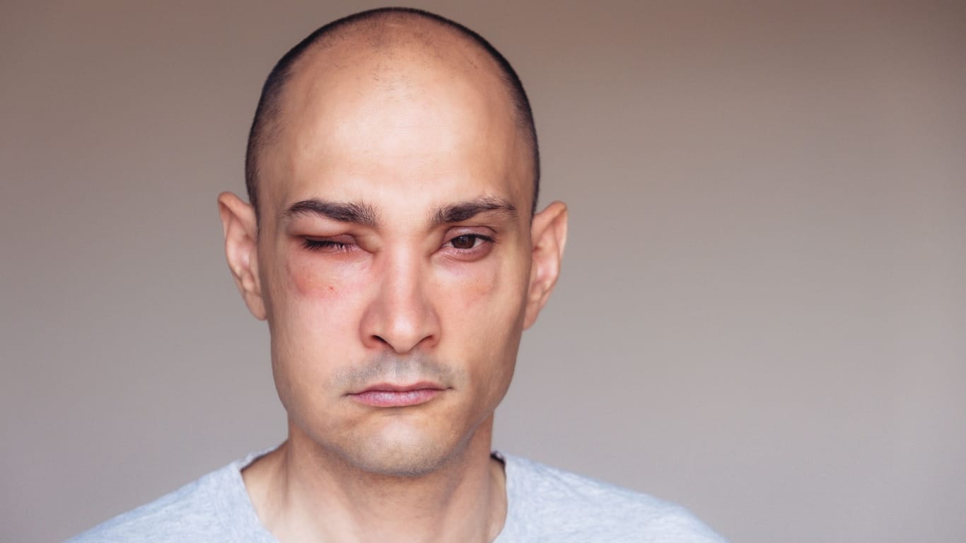 Ein Mann mit einem Angioödem im Bereich der Augen