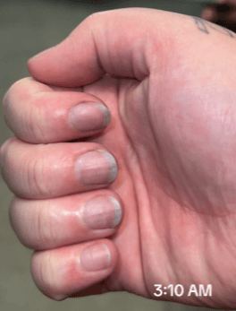 Auch die Finger nahmen blaue Farbe an.