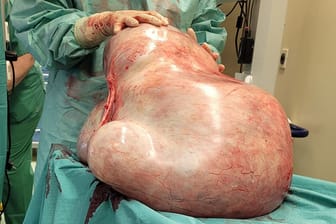 Der 32 Kilo schwere Tumor: Die Frau hatte Angst vor der OP.