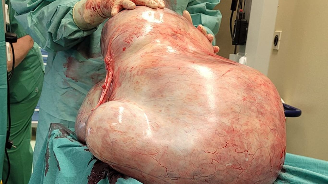 Der 32 Kilo schwere Tumor: Die Frau hatte Angst vor der OP.