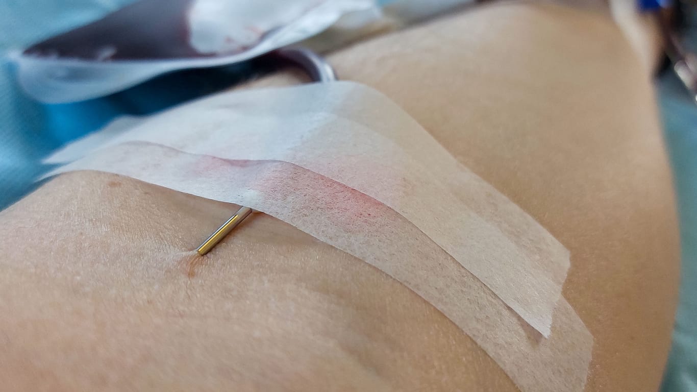 needle stuck in blood young person arm during blood transfusio
