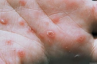 Syphilis zeigt sich, wie hier durch einen Hautausschlag, durch verschiedene Symptome.