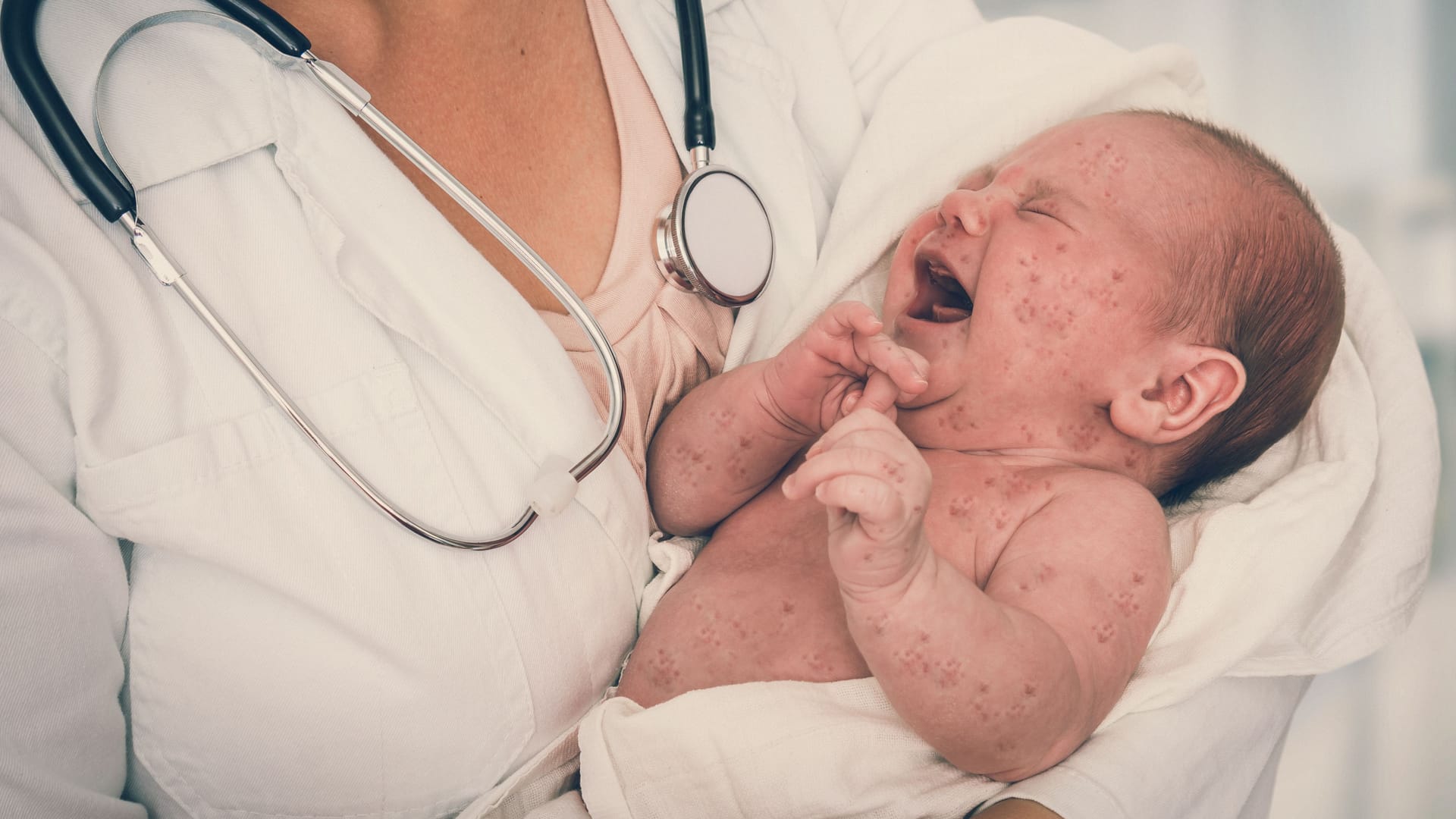 Ein Baby mit Masern (Symbolbild): Seit 2023 stellt das Landesamt für Gesundheit und Soziales (Lageso) wieder einen Anstieg der Maserninfektionen fest. Ein Baby mit Masern (Symbolbild): Seit 2023 stellt das Landesamt für Gesundheit und Soziales (Lageso) wieder einen Anstieg der Maserninfektionen fest.