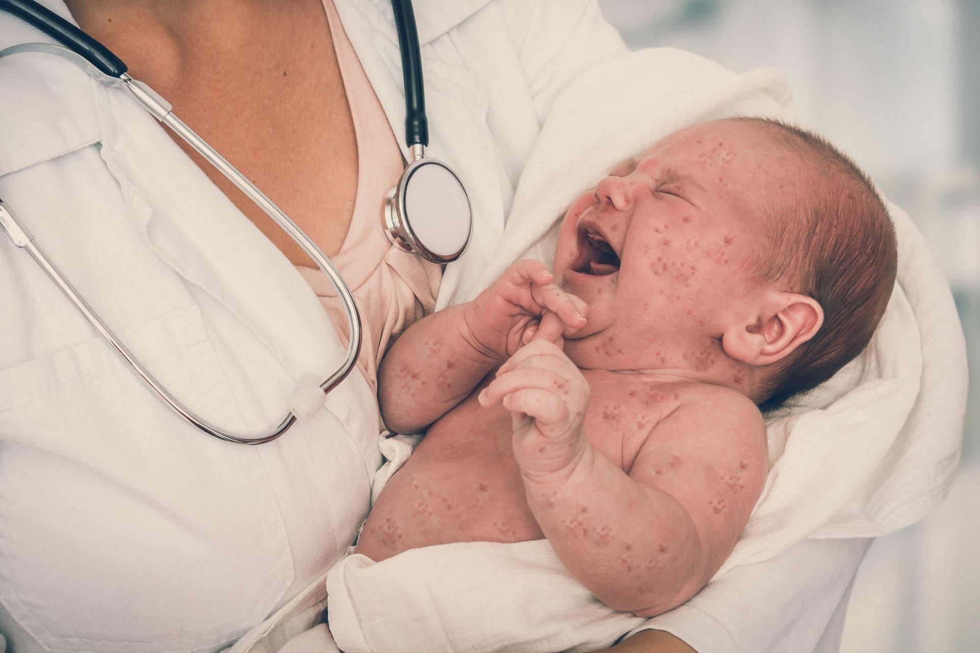 Ein Baby mit Masern (Symbolbild): Seit 2023 stellt das Landesamt für Gesundheit und Soziales (Lageso) wieder einen Anstieg der Maserninfektionen fest.