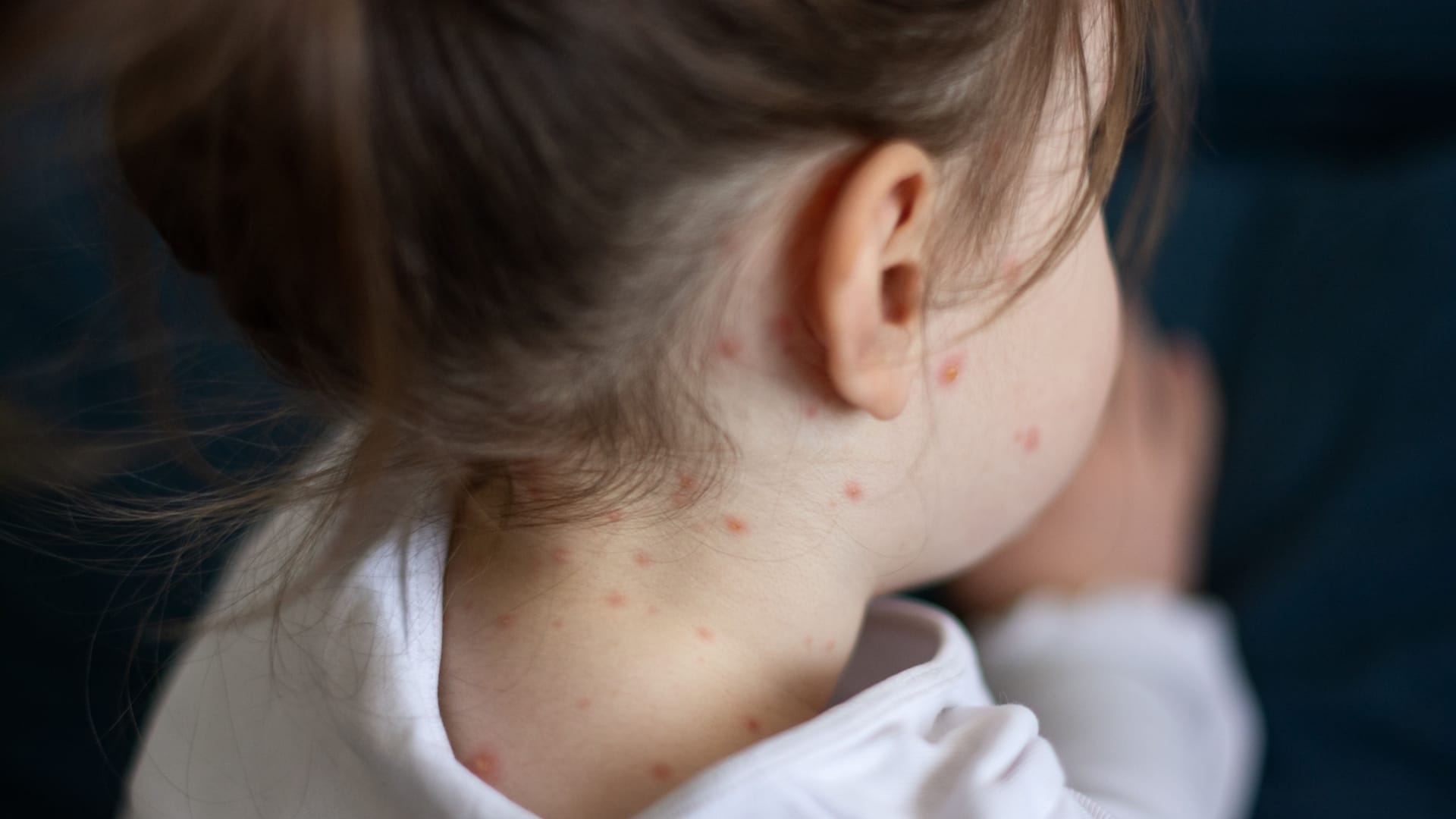 Ein Mädchen ist an Masern erkrankt (Symbolbild): Seit 2023 stellt das Landesamt für Gesundheit und Soziales (Lageso) wieder einen Anstieg der Fallzahlen in Berlin fest.