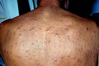 Starker Hautausschlag nach einer Syphilis-Infektion: Im zweiten Stadium kann sich die Krankheit am ganzen Körper zeigen.