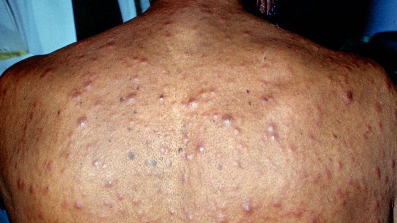 Starker Hautausschlag nach einer Syphilis-Infektion: Im zweiten Stadium kann sich die Krankheit am ganzen Körper zeigen.