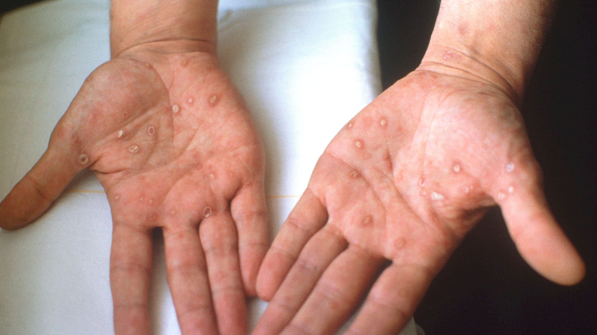 Hautausschlag auf den Händen (Symbolbild): Ein Symptom von Syphilis können rote Punkte auf der Haut sein.