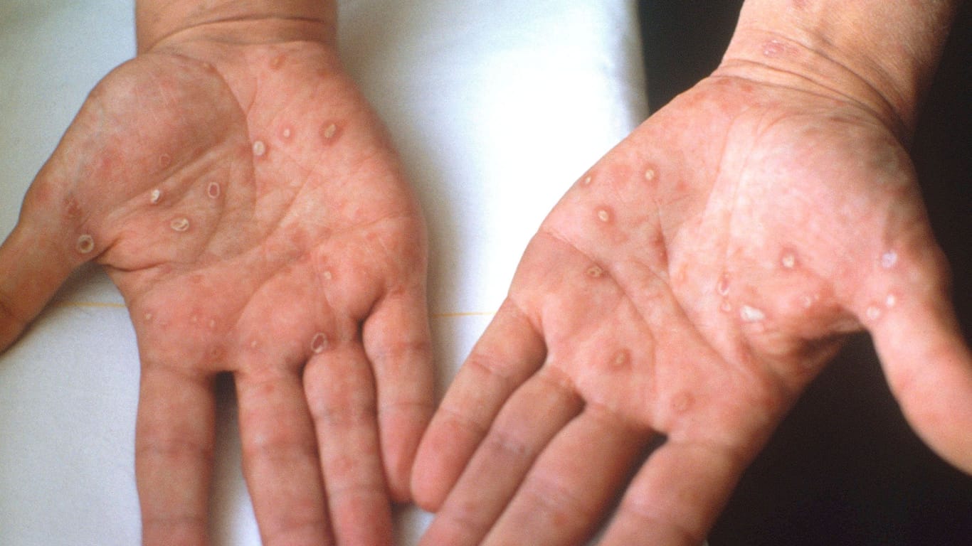 Hautausschlag auf den Händen (Symbolbild): Ein Symptom von Syphilis können rote Punkte auf der Haut sein.