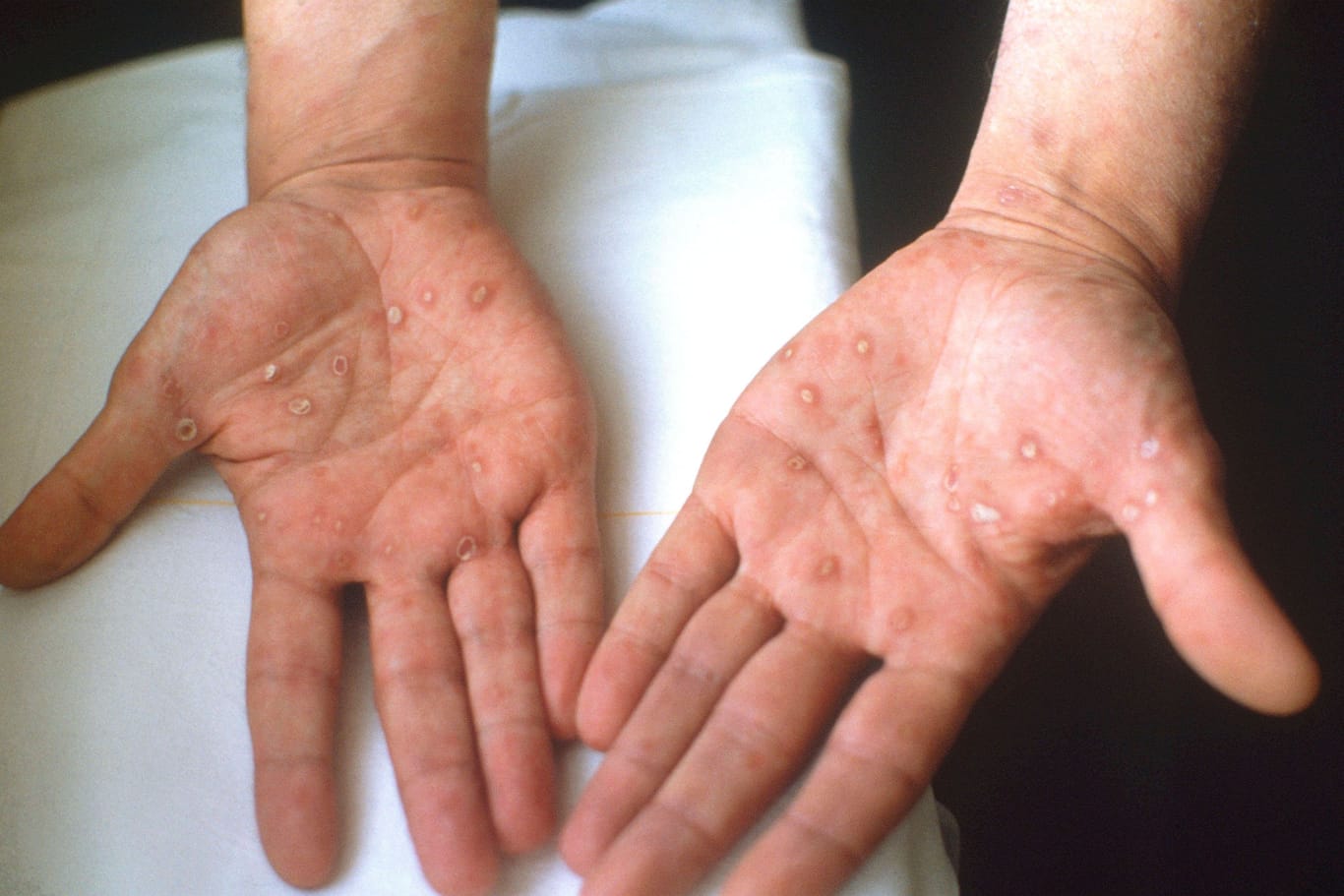 Hautausschlag auf den Händen (Symbolbild): Ein Symptom von Syphilis können rote Punkte auf der Haut sein.